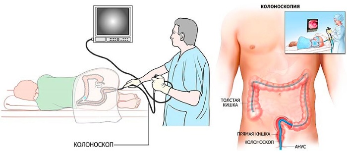 Колоноскопия под седацией. Что это такое, цена, отзывы