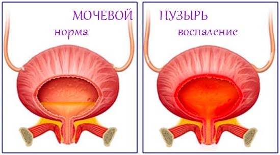 Цистит у женщин при беременности. Симптомы, лечение. Препараты, народные средства, антибиотики