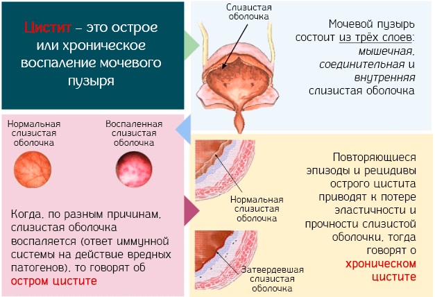 Моча оранжевого цвета у женщин. Причины, что это такое при беременности, цистите, ОРВИ, лечение