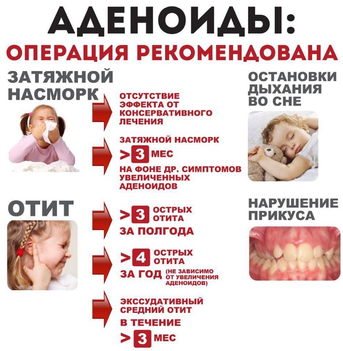 Удаление аденоидов у ребёнка 3-4-5 лет под общим наркозом. Отзывы, как проходит, за и против
