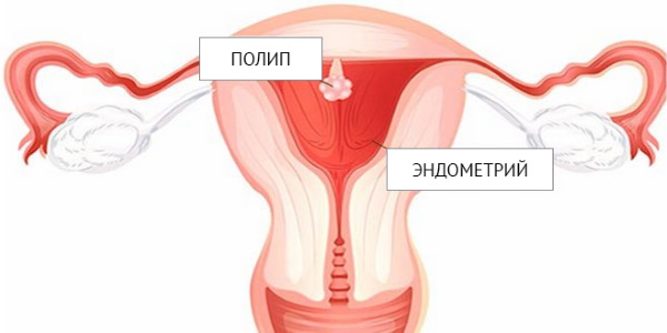 Удаление полипа матки лазером, гистероскопия эндометрия. Подготовка, восстановительный период