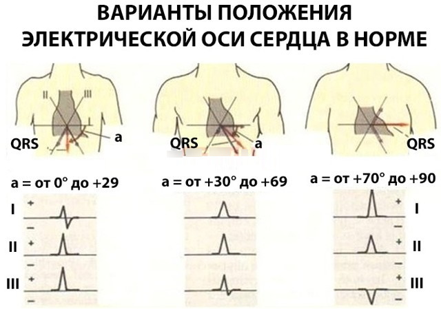 Угол альфа (α, ЭОС, электрическая ось сердца) на ЭКГ. Норма у взрослых, детей, как определить