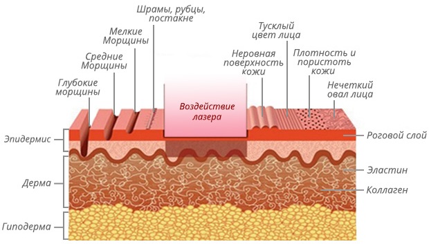 Угревая сыпь у подростков. Лечение препаратами, средствами из аптеки, народными, масками, лазером