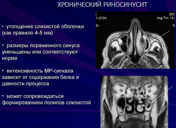 Утолщение слизистой оболочки верхнечелюстных пазух, ячеек решетчатого лабиринта. Что это, лечение