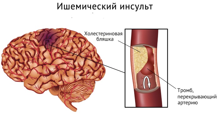 Микроинсульт у молодых девушек. Симптомы, возраст, лечение