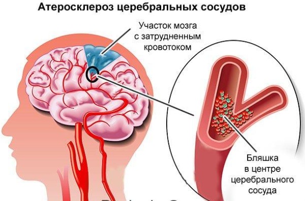 Витапрост Плюс (Vitaprost Plus) свечи. Инструкция по применению, отзывы, цена
