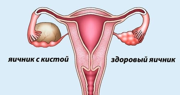 Визанна. Инструкция по применению при эндометриозе, беременности, миоме. Отзывы, побочные действия, цена