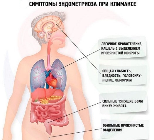 Визанна. Инструкция по применению при эндометриозе, беременности, миоме. Отзывы, побочные действия, цена