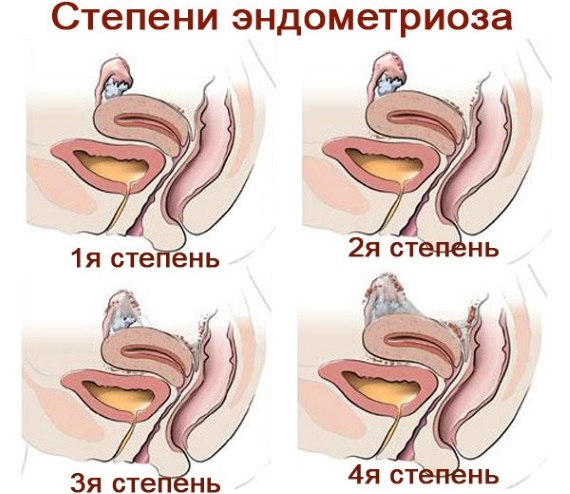 Непроходимость маточных труб. Что это такое, причины, признаки, лечение