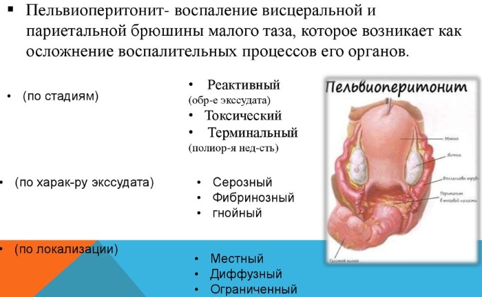 Воспаление матки и придатков. Симптомы и лечение, что это такое, причины, препараты, таблетки, народные средства