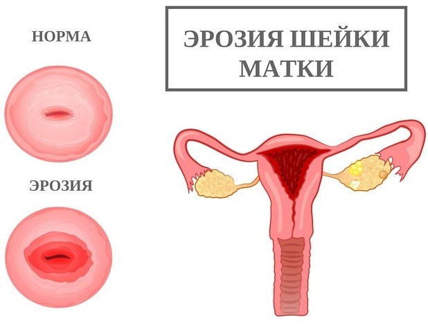 Воспаления по-женски придатков, почек, яичников, мочевого пузыря, лимфоузлов в паху, симптомы и лечение