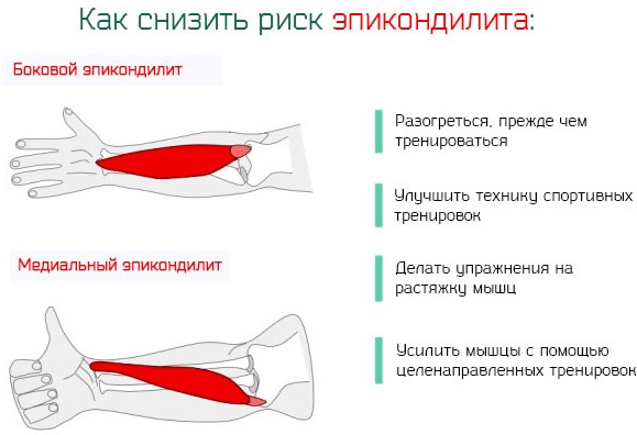 Воспаление (тендинит) сухожилий локтевого сустава. Лечение народными средствами, мазями