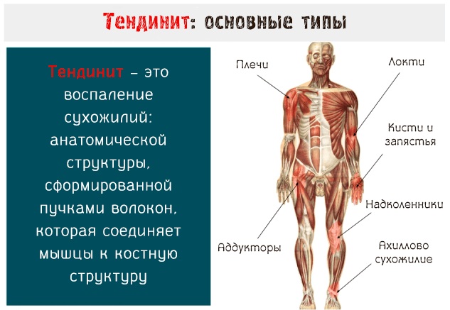 Воспаление (тендинит) сухожилий локтевого сустава. Лечение народными средствами, мазями