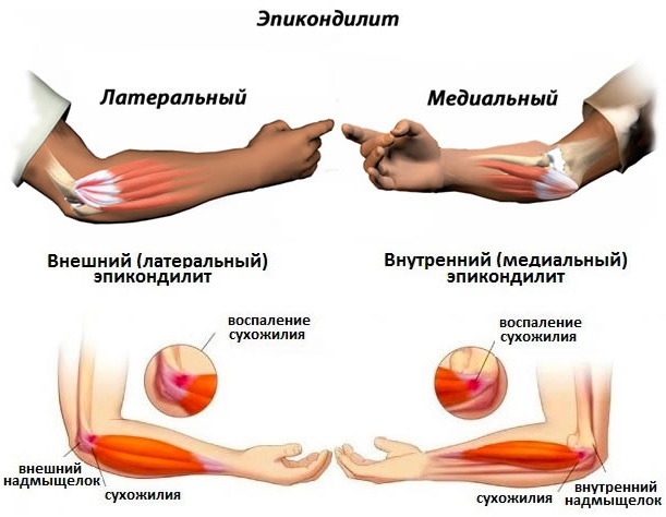 Воспаление (тендинит) сухожилий локтевого сустава. Лечение народными средствами, мазями