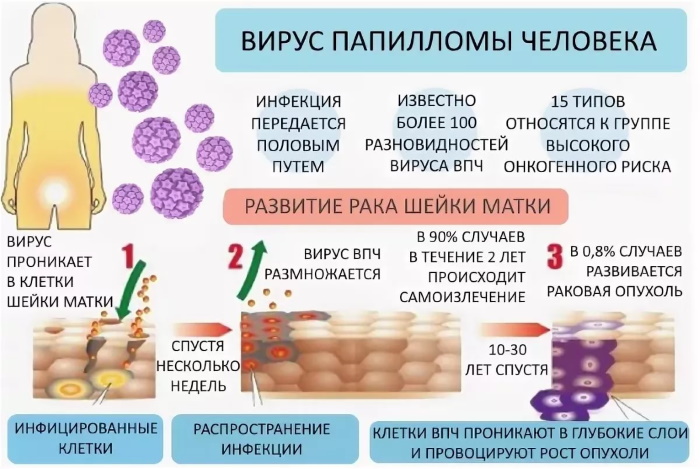 ВПЧ типы у женщин и мужчин: 16, 18, 31, 51, 56, 39, онкогенные, высокоонкогенные. Лечение