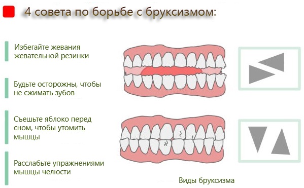 Как вставить имплант зуба. Виды, цена, больно ли, как это делается, отзывы