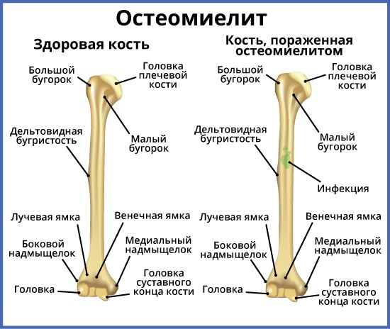 Как вставить имплант зуба. Виды, цена, больно ли, как это делается, отзывы