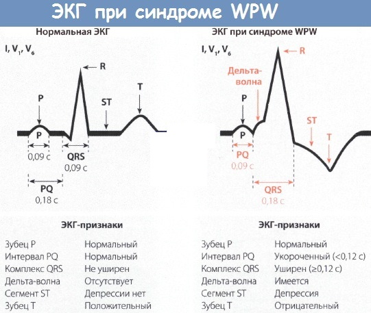 WPW (ВПВ) синдром ЭКГ. Признаки, что это