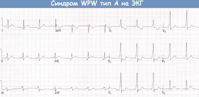 WPW (ВПВ) синдром ЭКГ. Признаки, что это