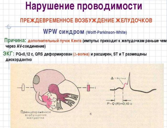 WPW (ВПВ) синдром ЭКГ. Признаки, что это
