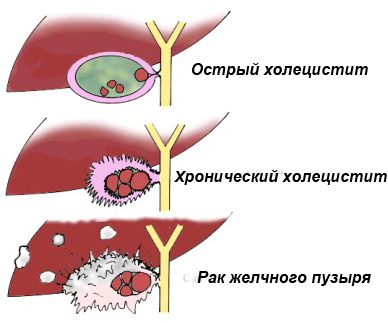 Заболевания печени и желчного пузыря. Симптомы, лечение