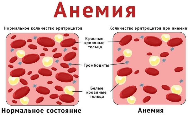 Лопаются капилляры на ногах, появляются синяки, пятна. Что делать, причины и лечение