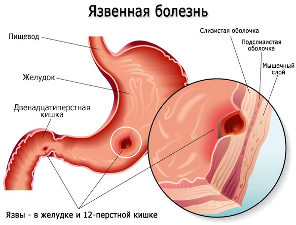 Густая желчь. Причины и лечение, симптомы, что делать, лекарства, диета
