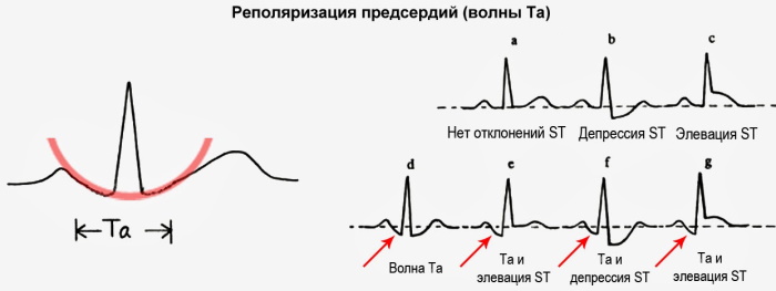 Зубец Р (R) на ЭКГ. Что отражает, характеризует, норма