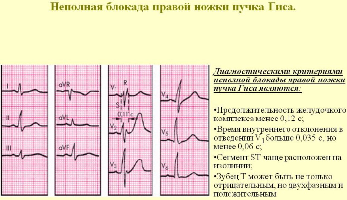Зубец Р (R) на ЭКГ. Что отражает, характеризует, норма