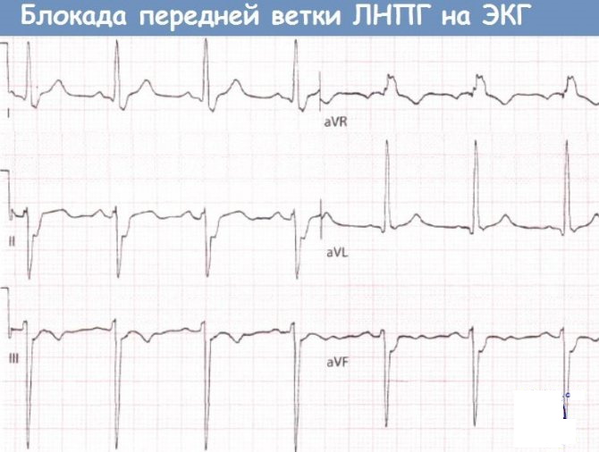 Зубец Р (R) на ЭКГ. Что отражает, характеризует, норма