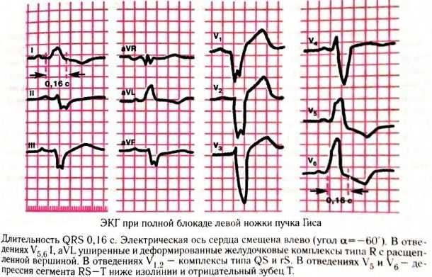 Зубец Р (R) на ЭКГ. Что отражает, характеризует, норма