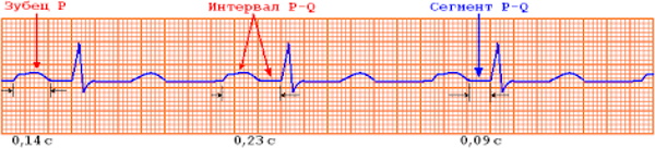 Зубец Р (R) на ЭКГ. Что отражает, характеризует, норма